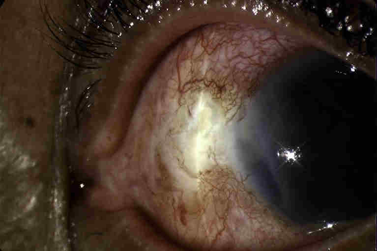 Fig. 4 Fungal scleritis with hypopyon