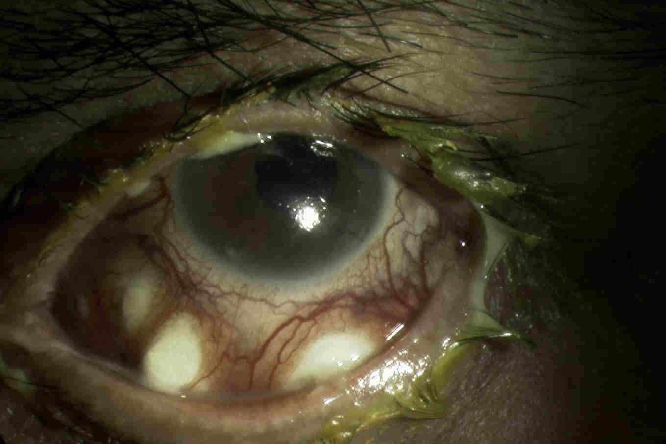 Fig. 3 Surgically induced necrotising scleritis following diabetic vitrectomy