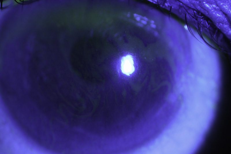 Cataract surgery and dry eye eyeonoptics