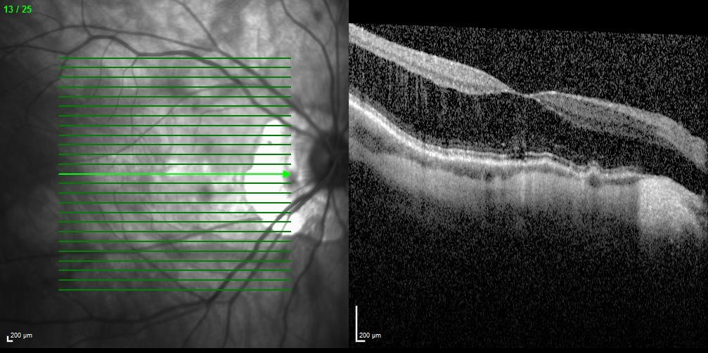 Figure 2: Myopic macula schisis with a thicker inner layer and a thinner outer layer at the macula
