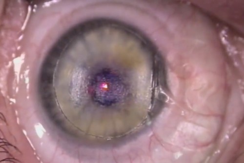 what causes refractive error after cataract surgery