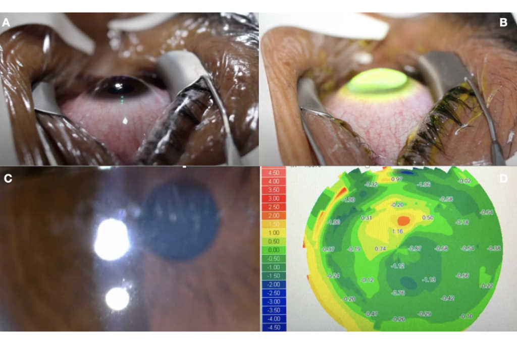 Corneal Crosslinking In 2020 Eyeonoptics 