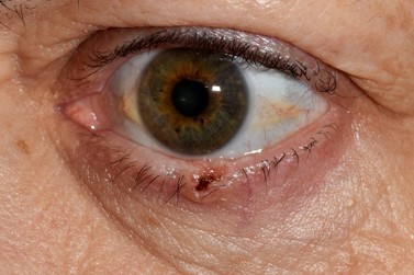 basal cell carcinoma eyelid