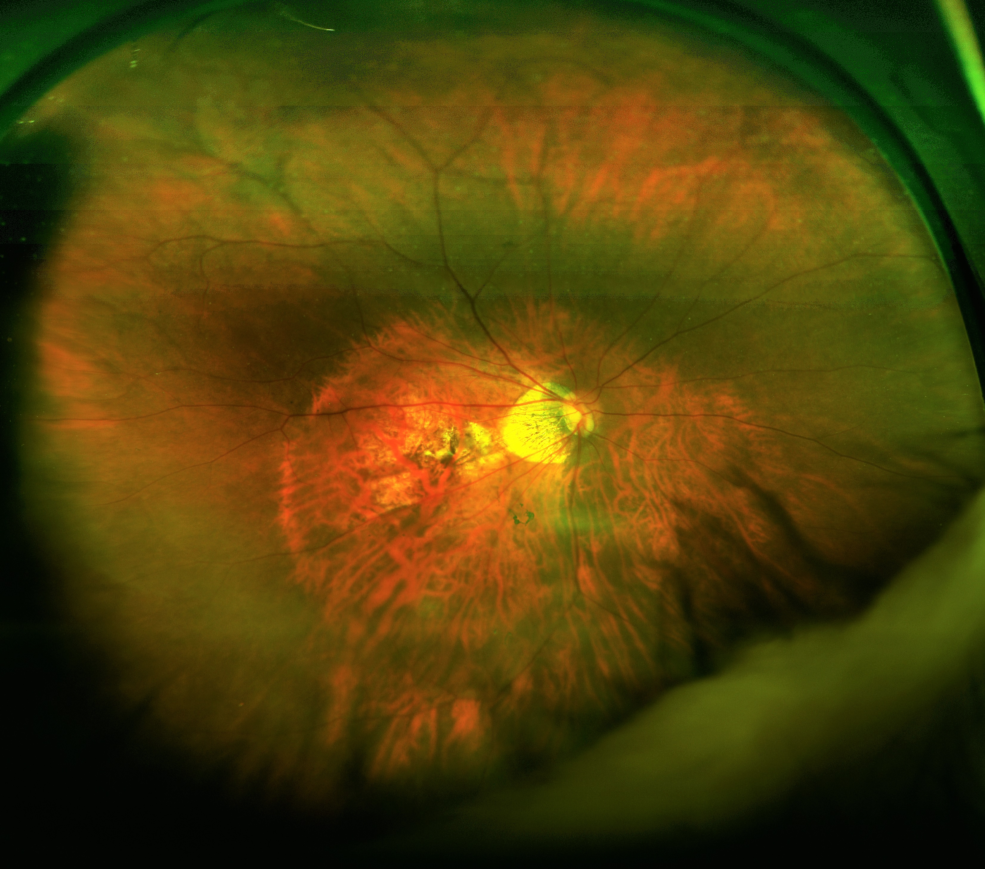 Figure 1: Widefield optos image of myopic fundus demonstrating a tessallated fundus, tilted optic disc with a myopic cone and macula atrophy. The outline of a poterior staphyloma is also visible