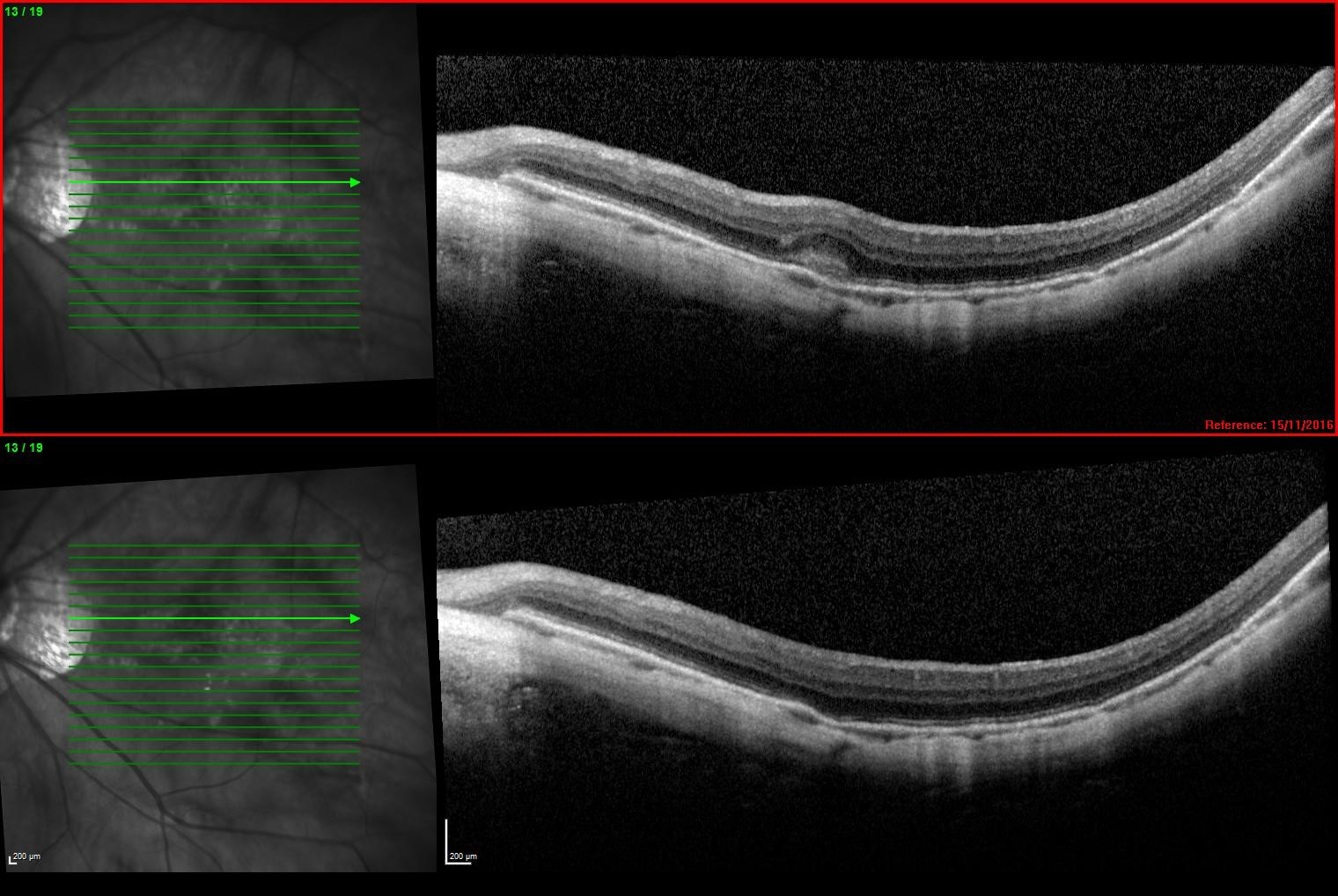 Figure 4: SD OCT with a newly diagnosed myopic CNV (above) and the same CNV 1 month following a singel intravitreal Bevacizumab injection (below)