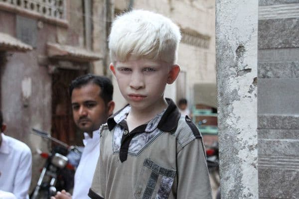 CLs in albinism – BLENNZ’s akonga experience