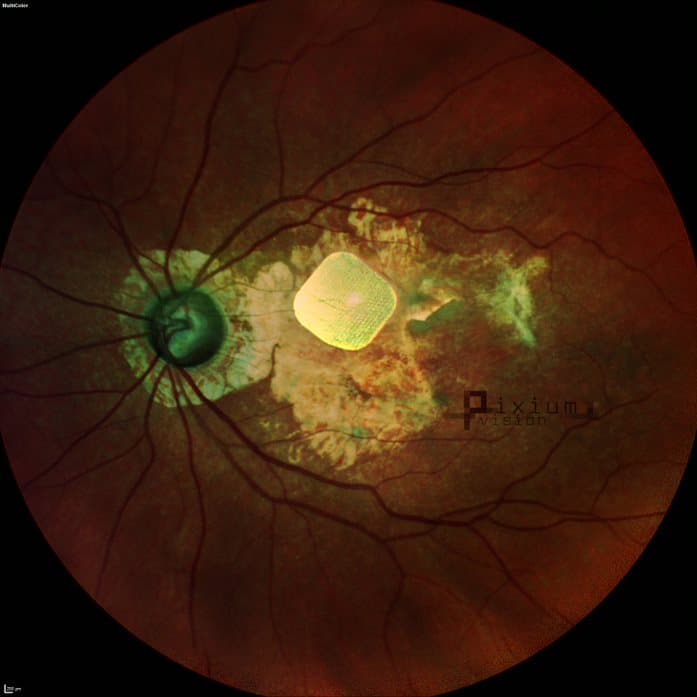 Bionic eye success-fundus.jpg