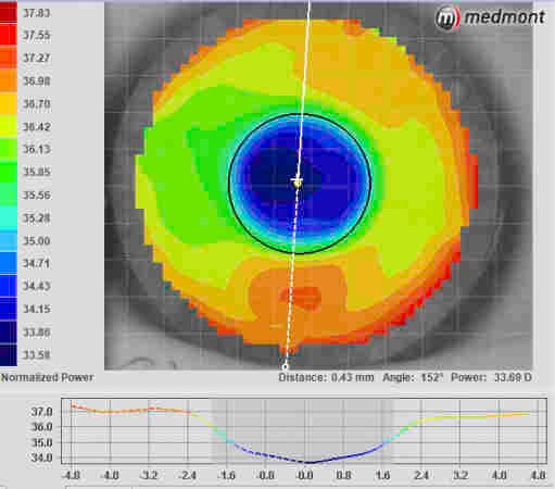 Non-ortho-k CL options for myopia control-fig-8.jpg