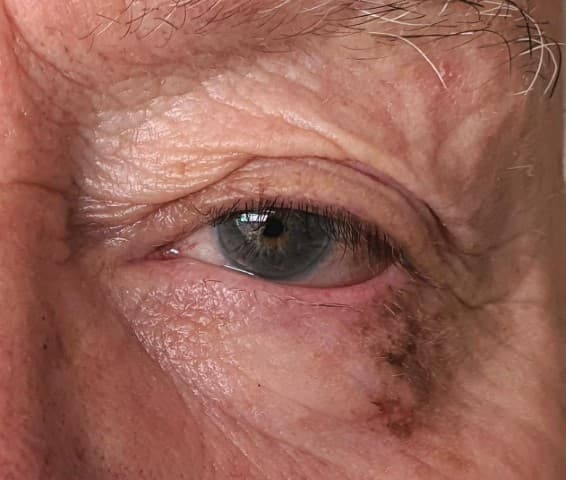 Melanoma Case 2