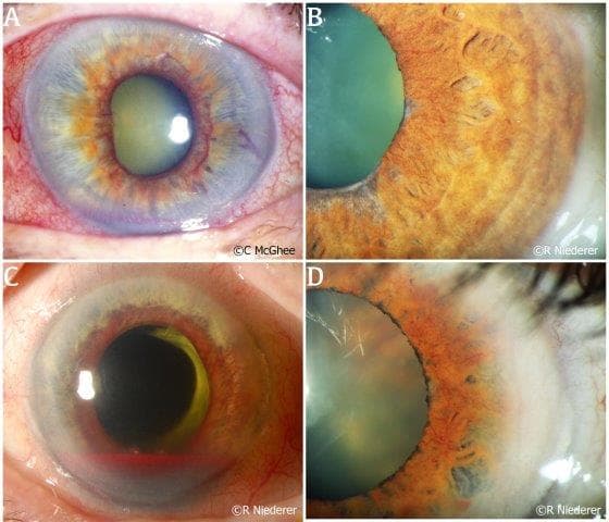 The iris in health and disease, part II: Iris transillumination defects and rubeosis iridis-fig-3.jpg
