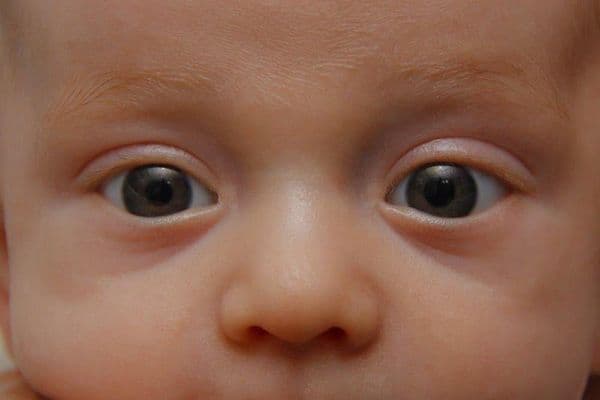 Foveal hypoplasia genes revealed
