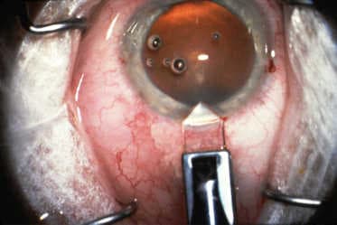 Incision insights on SIA