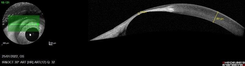 A rare but profound cause of corneal thinning-terrien-case-figure-3.jpg