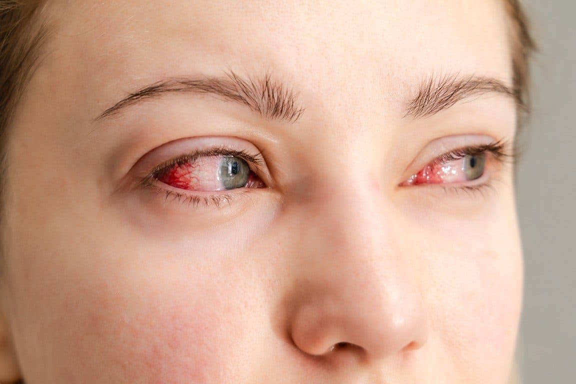 red irritated eyes conjunctivitis allergies
