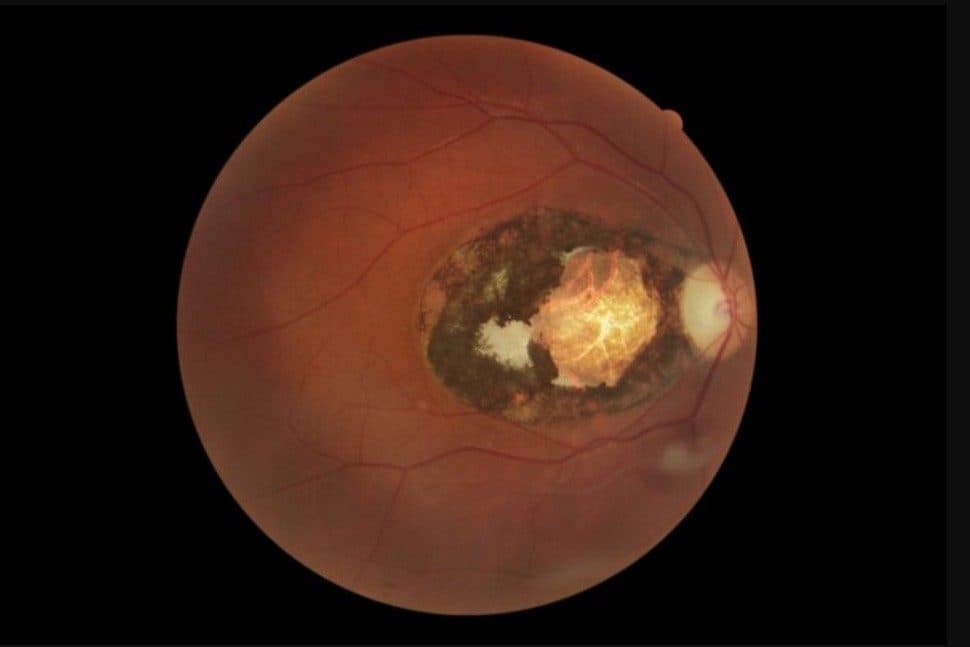 Macular lesion