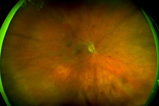 UWF imaging improves DR grading