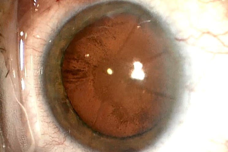CASE STUDY: A new option for restoring vision with irregular corneas-lahood-case-study-fig-1.jpg