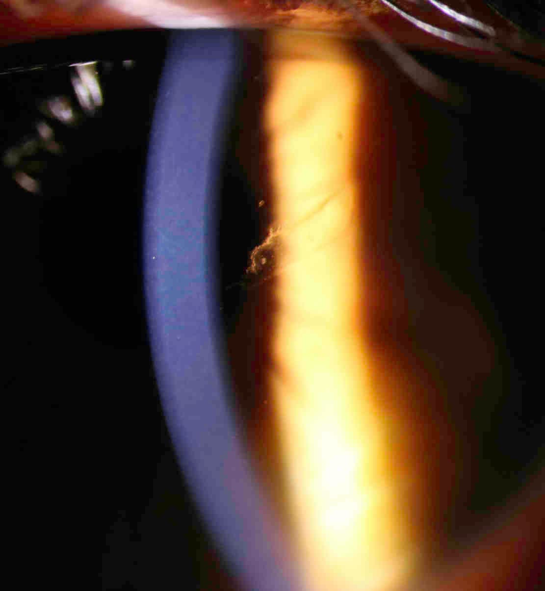 Bandage Contact Lenses-fig-1.jpg