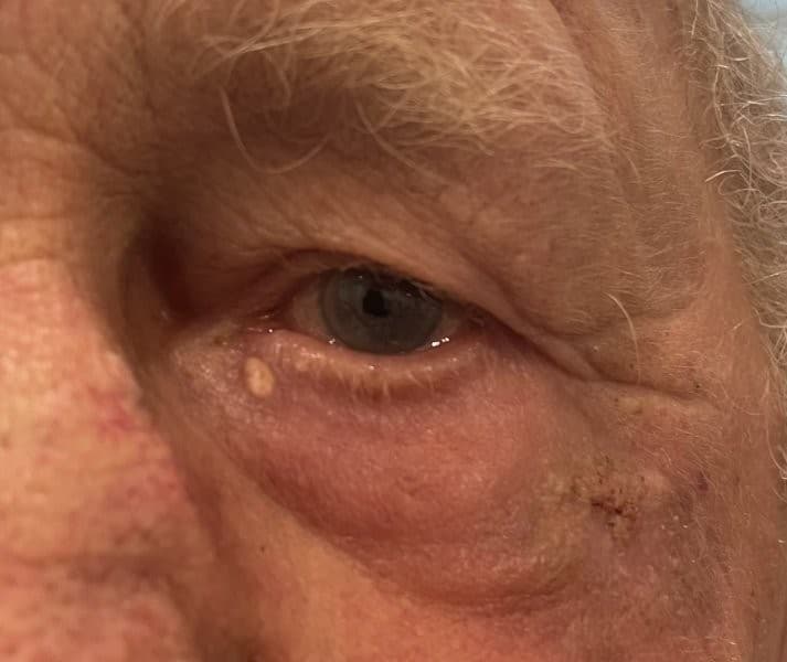 Pyoderma 2