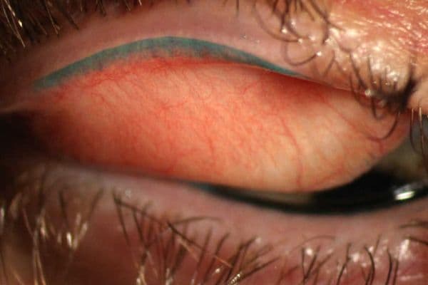 OSL: LWE trumps corneal staining for DED