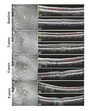 Dual triggers revealed for AMD-amd-drusen-and-sdds.jpg
