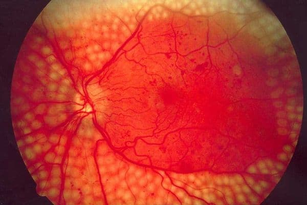 Australia funds diabetes screening