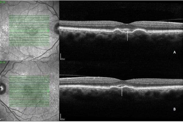CASE STUDY: non-neovascular subretinal fluid in AMD (1)