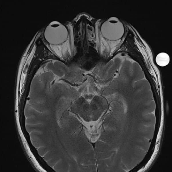 MRI Scan