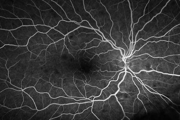 Thrombotic microangiopathy with Purtscher’s-like retinopathy findings