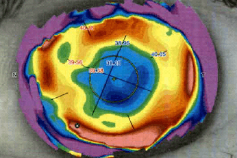 CASE STUDY: A new option for restoring vision with irregular corneas-lahood-case-study-fig-2.png