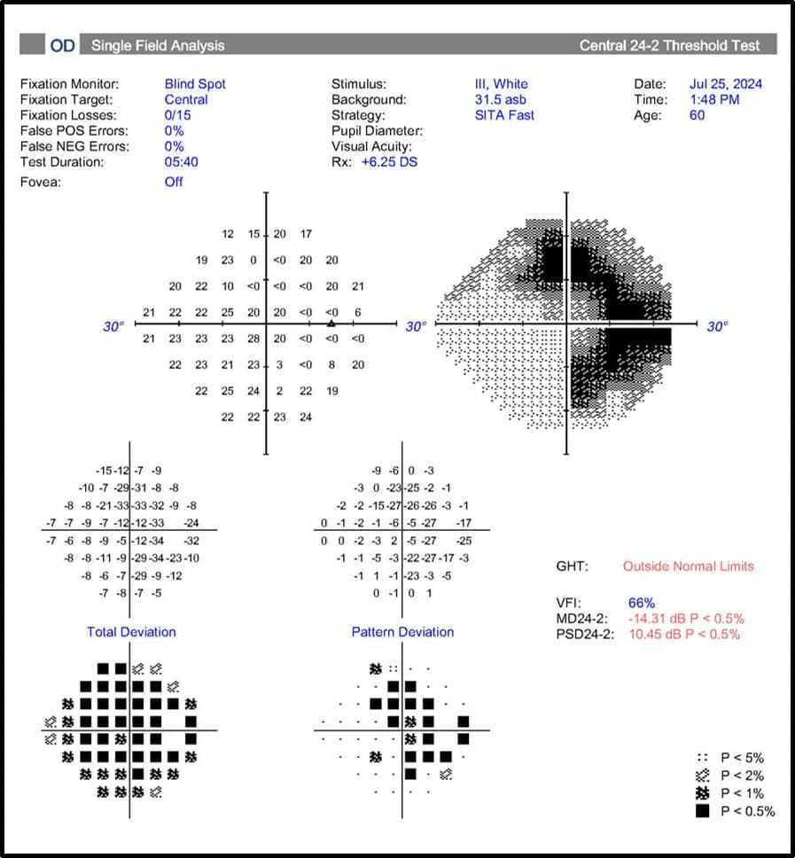 Right eye visual field test showing a bitemporal defect, with significant loss in the superior and inferior temporal fields.