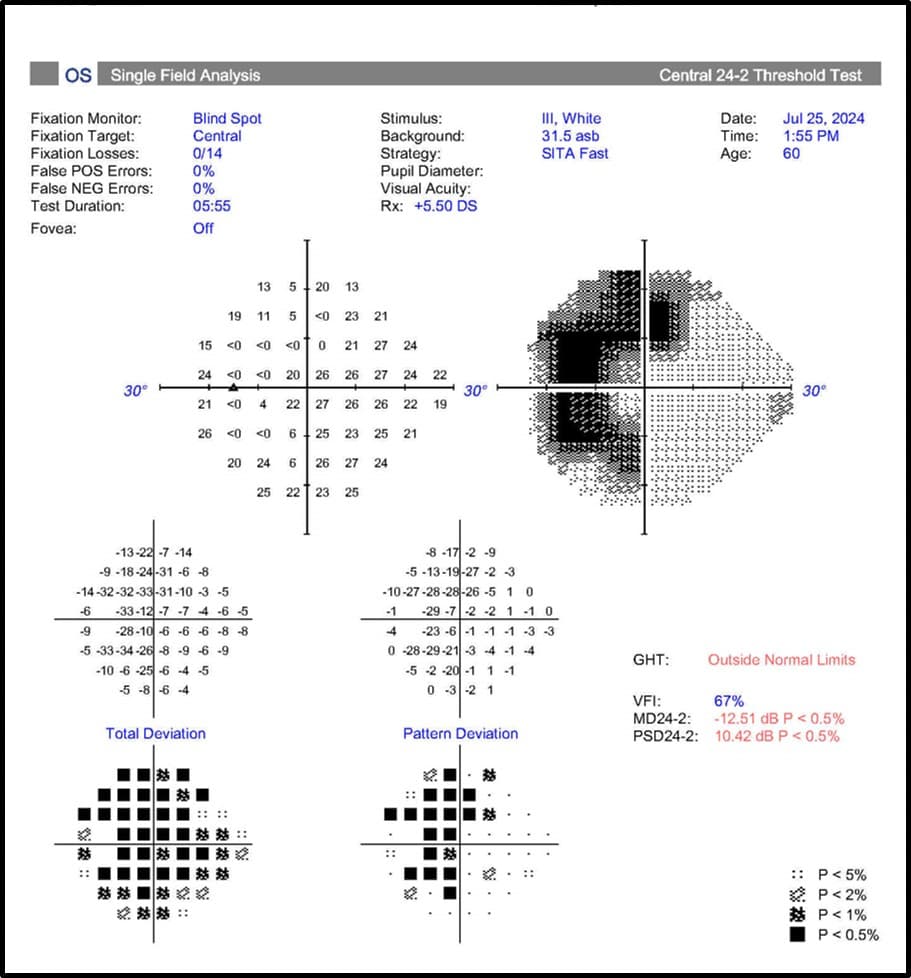 Left eye visual field analysis showing a bitemporal defect, with GHT outside normal limits and VFI 67%