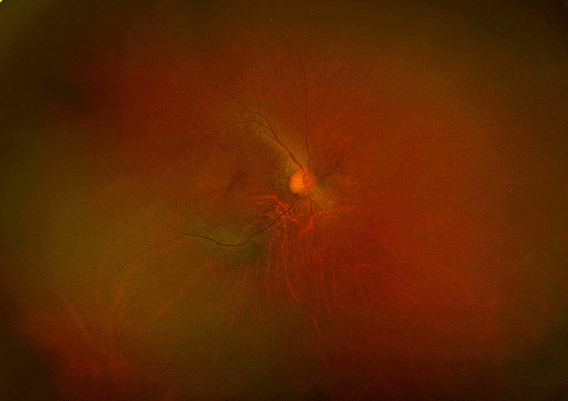Fundus photograph of the retina showing the optic disc, blood vessels, and surrounding reddish-orange tissue