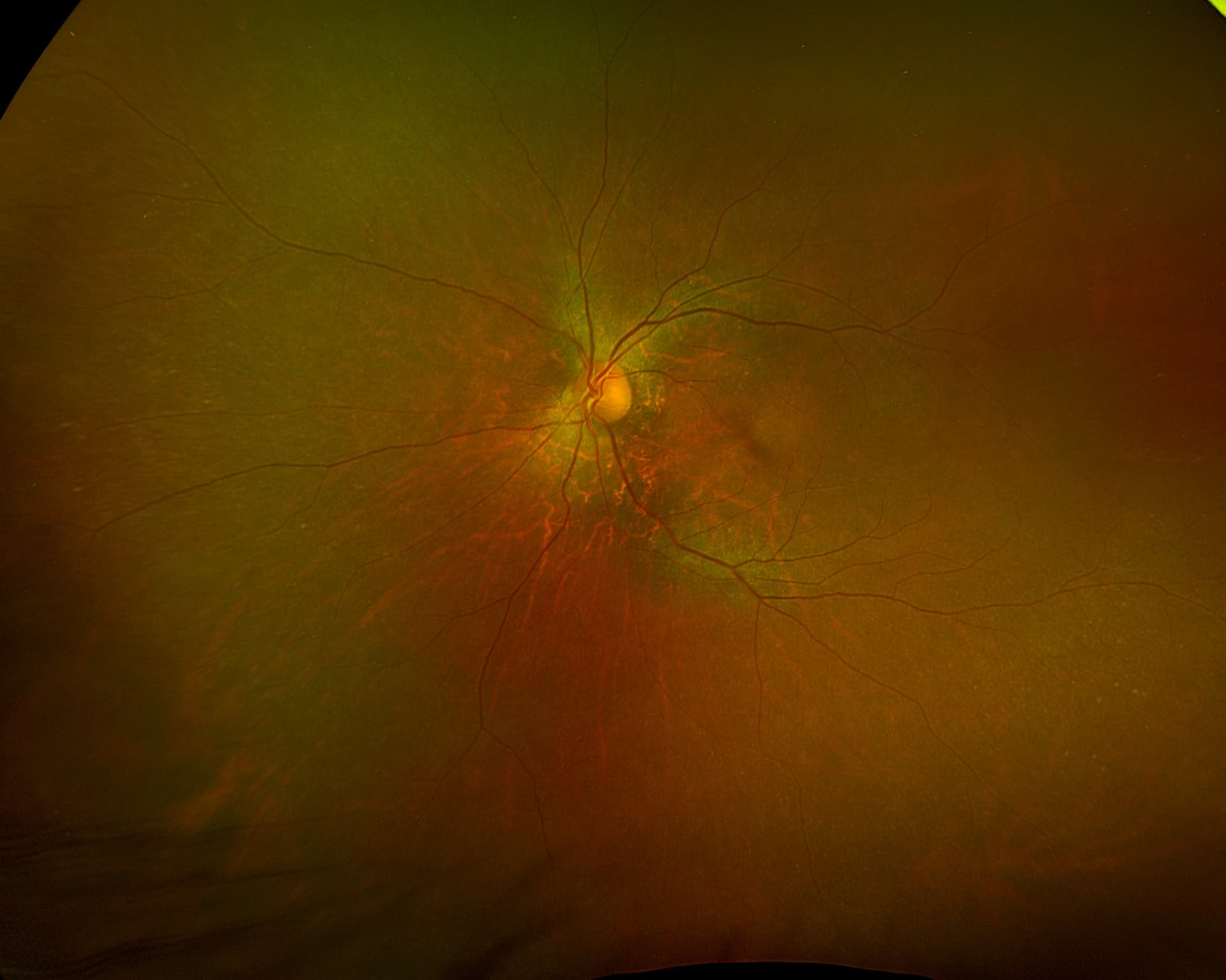 Wide-field fundus image of a human retina, showing the optic disc, retinal blood vessels, and macula.
