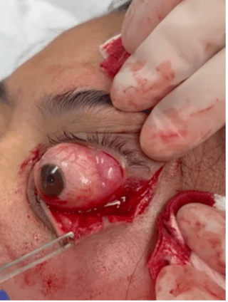 lateral canthotomy 