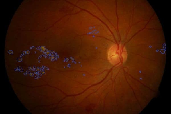 AI picks up early diabetic retinopathy