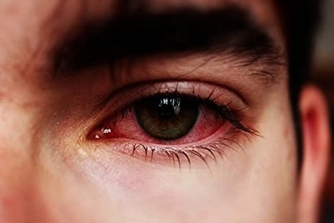 red eye