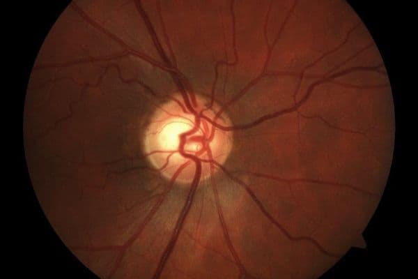 Case study: visual recovery after decompression