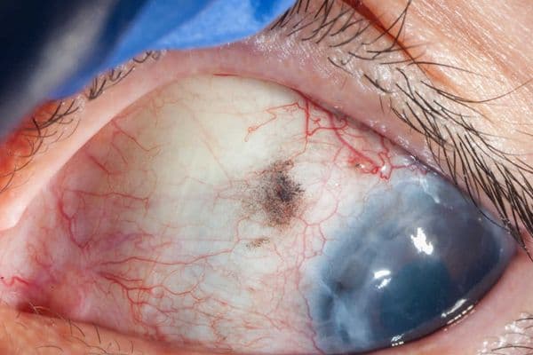 Under pressure from glaucoma (1)