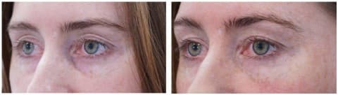 Blepharoplasty goes viral-blepharosplasty-online-extra-pic.jpg