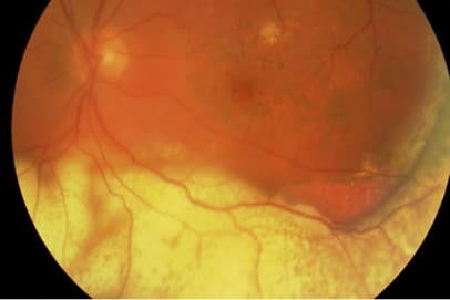 The complex diagnosis of intraocular lymphoma