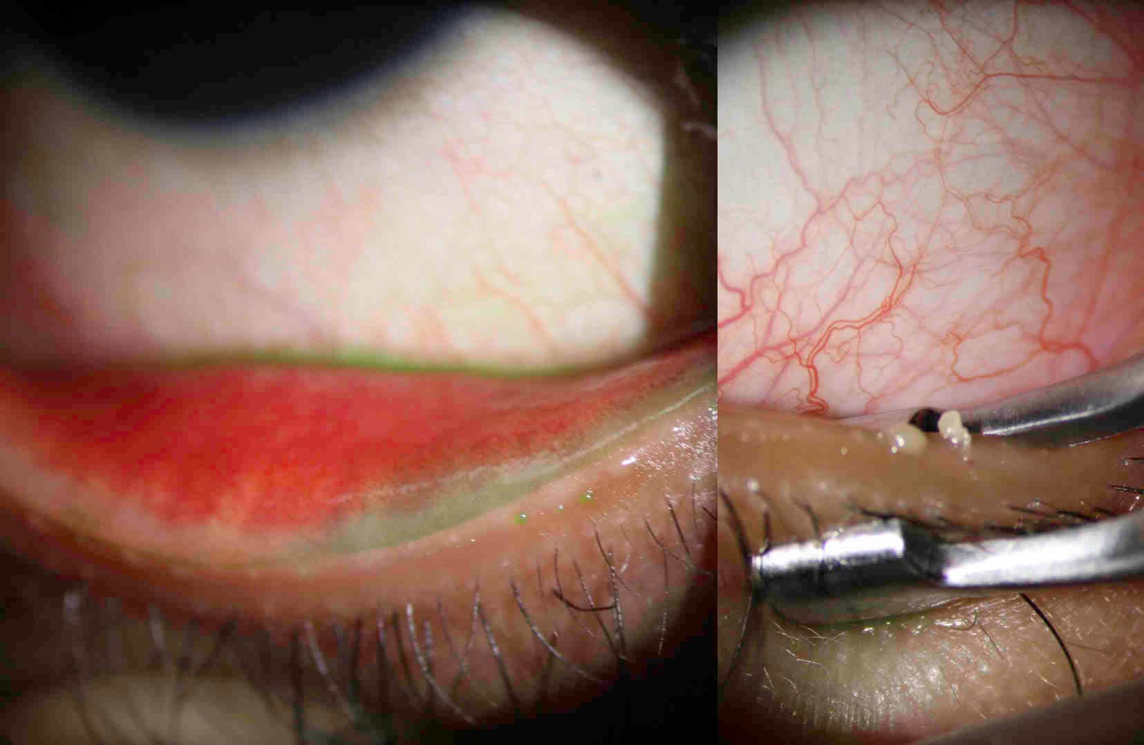 Bandage Contact Lenses-fig-3.jpg