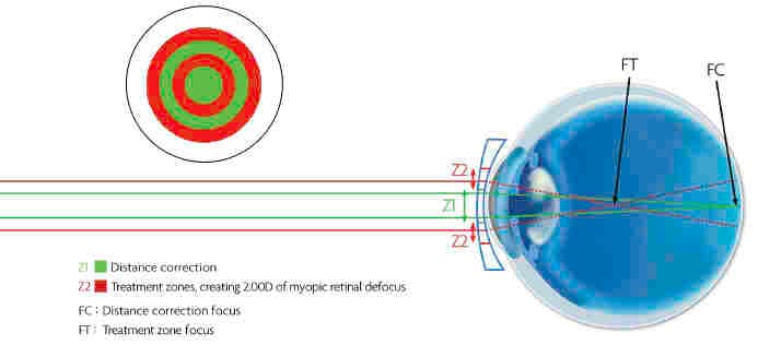 Non-ortho-k CL options for myopia control-fig-2.jpg