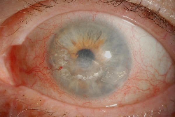 Valacyclovir shows promise against HZO