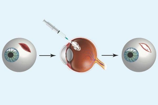 Portable glue for eye emergencies