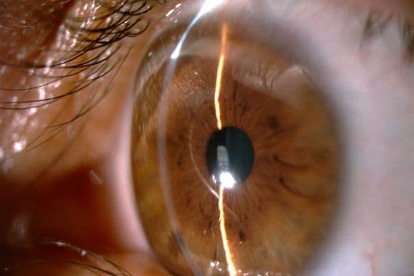 Unravelling the mystery of corneal peripheral thinning disorders