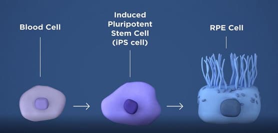 Stem cell trial for dry AMD on cards-20190116-nei-how-ispc-works_0.jpg
