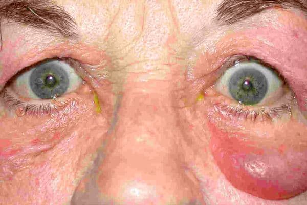 Thyroid-associated ophthalmopathy