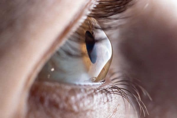 Help battle keratoconus in NZ