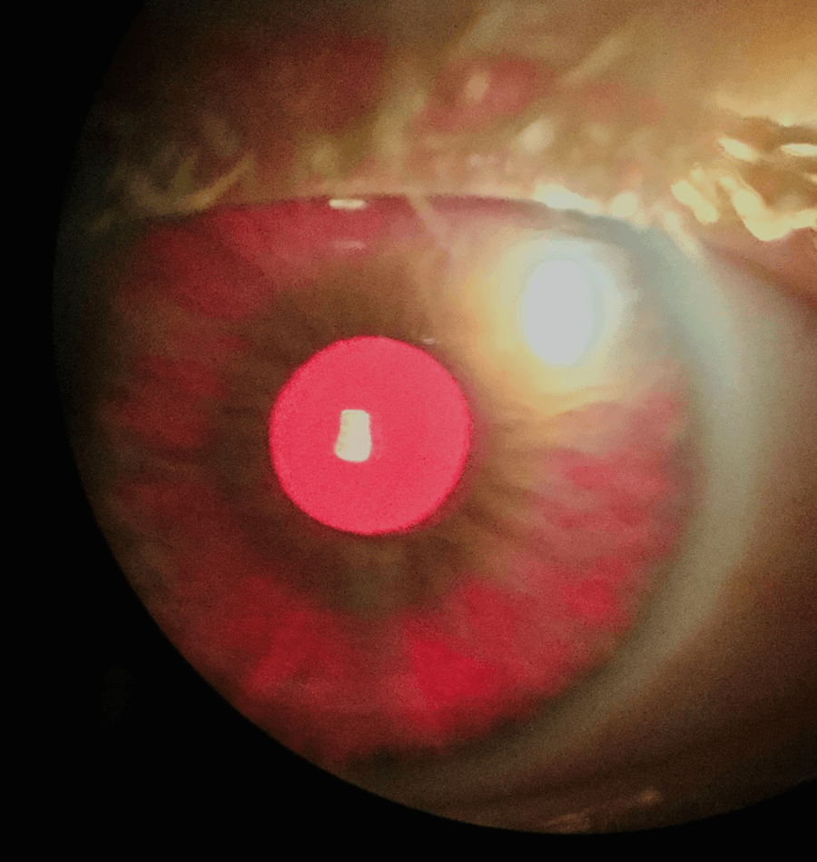 CLs in albinism – BLENNZ’s akonga experience-fig-1.png